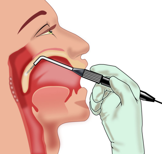 The picture shows how to do palatoplasty with the laser