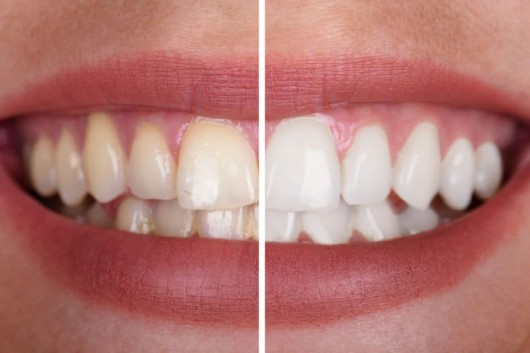 A close up picture of teeth before and after teeth whitening procedure