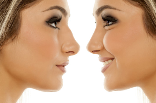 Comparison of female nose, before and after scarless rhinoplasty