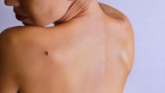 Can Mohs Surgery Get Rid of Skin Cancer?
