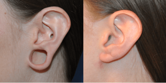 A close up picture of the ear before and after earlobe restoration