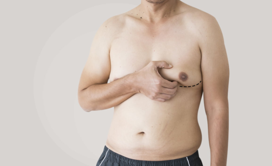 A man with gynecomastia. He is holding his breast between two fingers