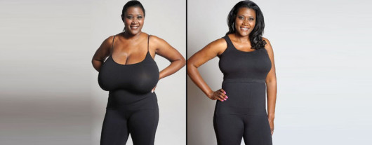 An image of a girl before and after breast reduction surgery