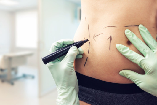 A surgeon is making marks on the girls body before the body lift surgery