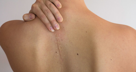 A close up image of girls back with a hypertrophic scar on grey background