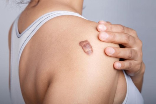 A close up shoulder of a woman in white bra on grey background with keloid scar