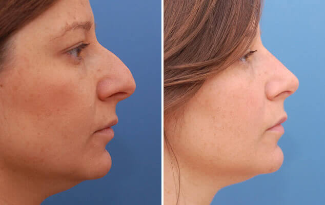 An image of a woman before and after the the rhinoplasty procedure