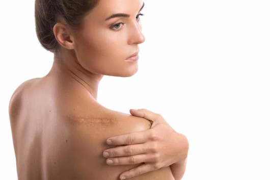 A girl on white background with a big scar on her shoulder