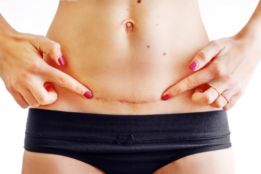 A woman is pointing out to the scar at the bottom of her belly after the tummy tuck surgery