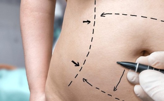 A close up image of a big belly with excessive fat with doctor's marks before liposuction