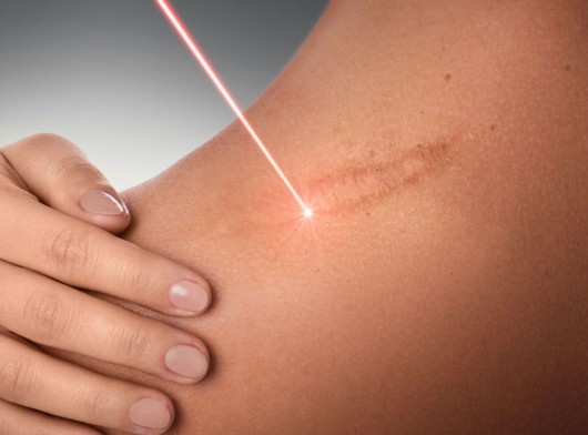 Scar revision surgery with a laser
