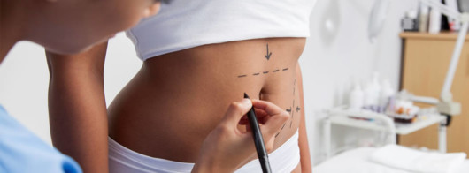 A doctor is putting marks on the woman belly before a mini tummy tuck procedure
