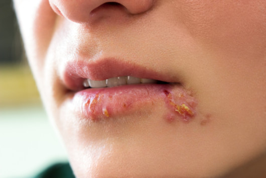 Girl lips showing herpes blisters