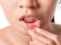 Asian women have aphthous ulcers on mouth on white background