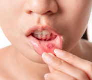 Asian women have aphthous ulcers on mouth on white background