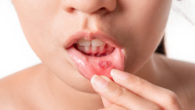 Asian women have aphthous ulcers on mouth on white background