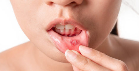 Asian women have aphthous ulcers on mouth on white background