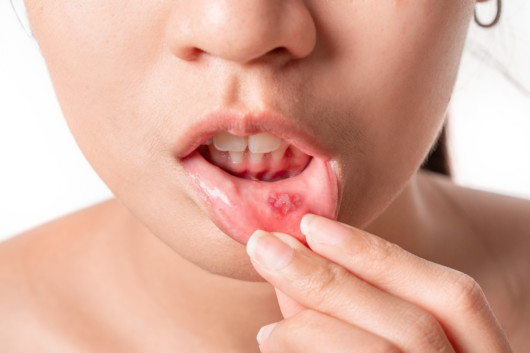 Asian women have aphthous ulcers on mouth on white background