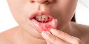 What Causes Mouth Sores And How To Treat Them