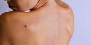 Can Mohs Surgery Get Rid of Skin Cancer?